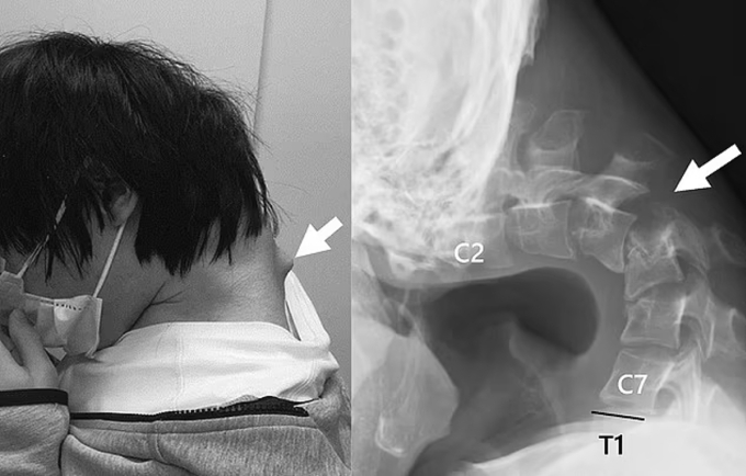 Cổ của chàng trai bị biến dạng do cúi đầu quá nhiều. Ảnh: Daily Mail