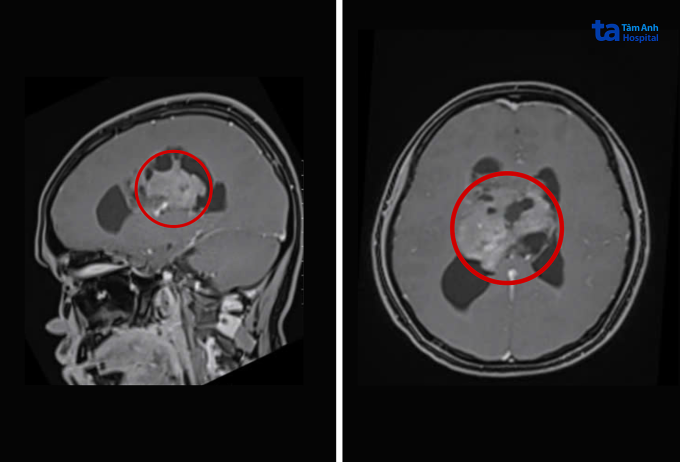Chụp MRI khối u 6 cm nằm sâu trong não thất của Thảo.